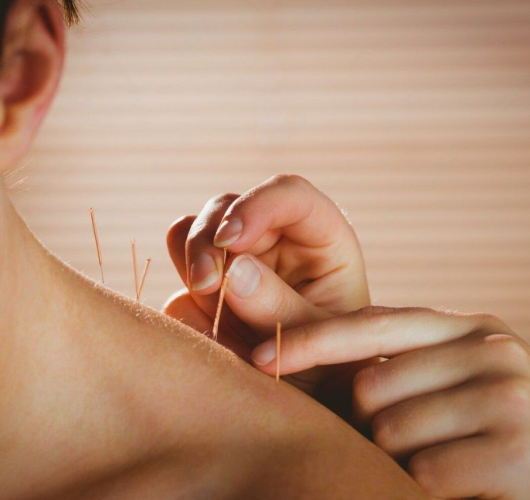 Acupuncture needles in shoulder for natural pain relief